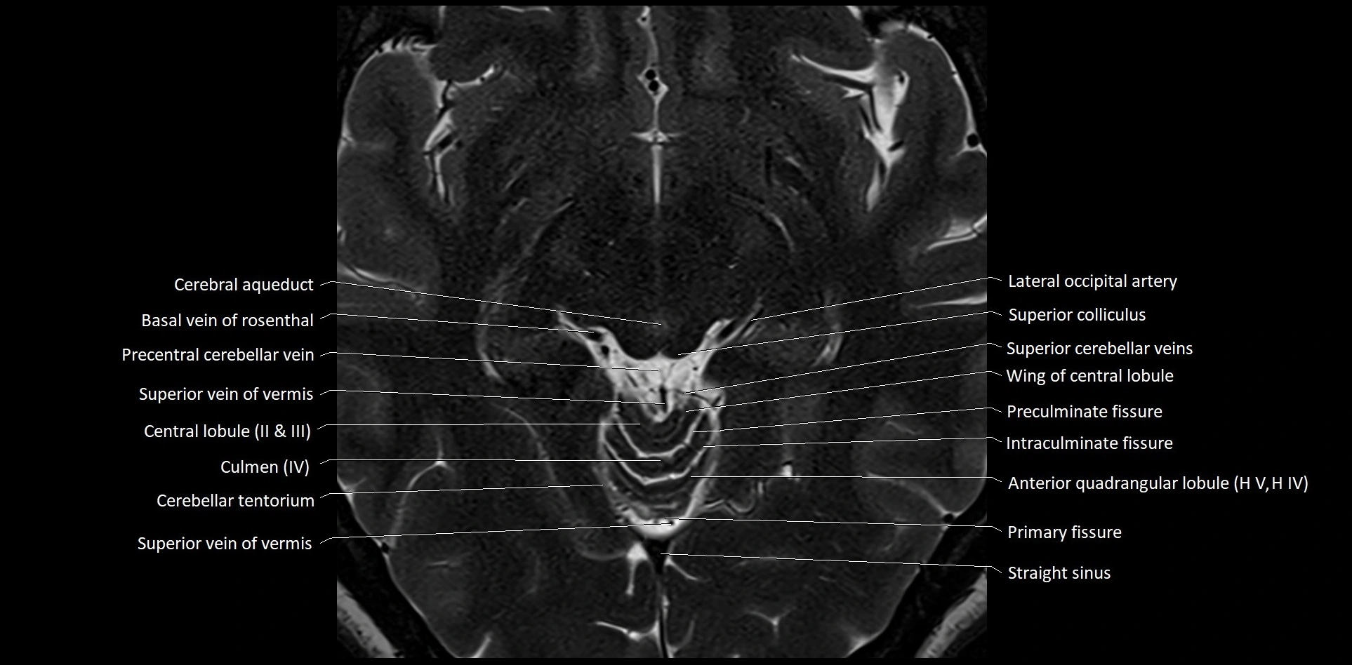 MRI Cerebellar anatomy High-resolution labelled 3T MRI image 27.webp